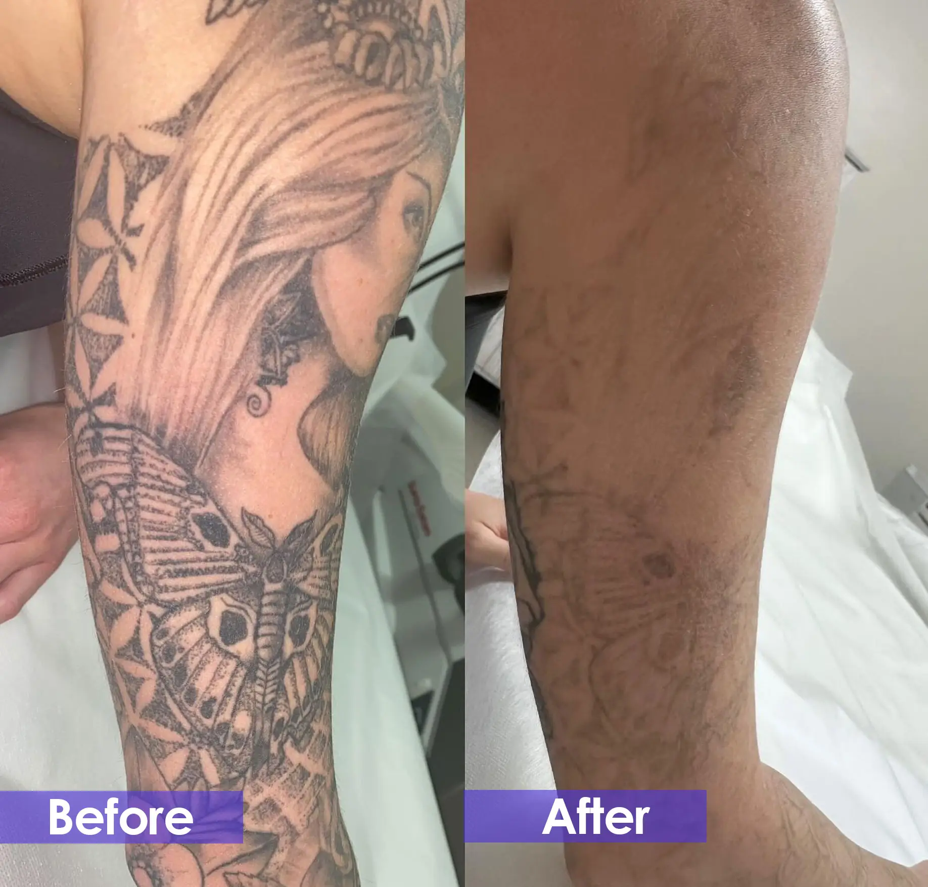after pico laser treatment - Arm tattoo removal